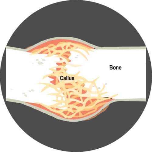 근육 생성 원리-부러진 뼈의 재생