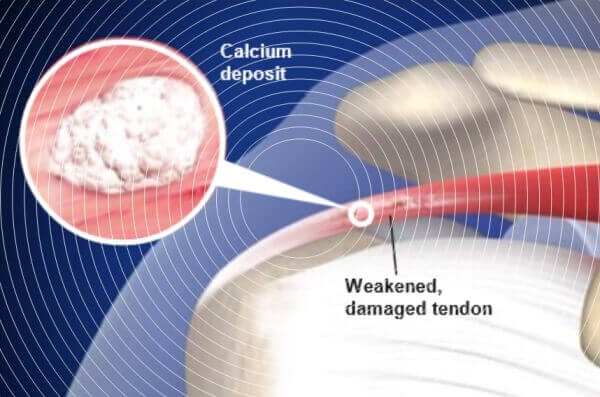 통증의 유형 : 어깨 힘줄과 석회, 석회화건염