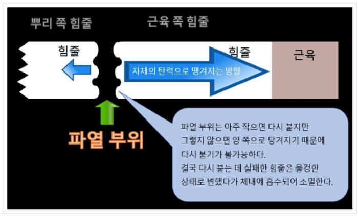 수술 or 비수술 중 선택은 : 힘줄 파열 시에는 다시 붙기가 매우 어렵다