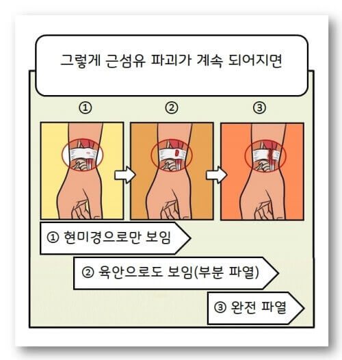 활동과 부상 이유 : 손목 인대 파열 장면 그림