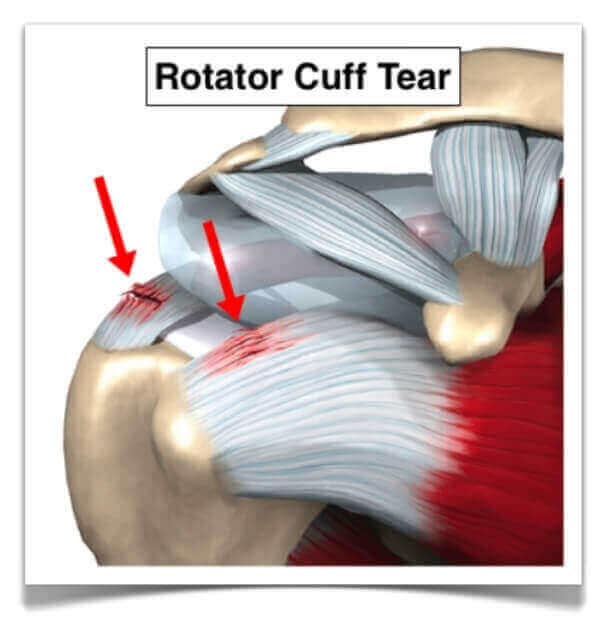 파열의 공식 : 로테이터 커프 테어